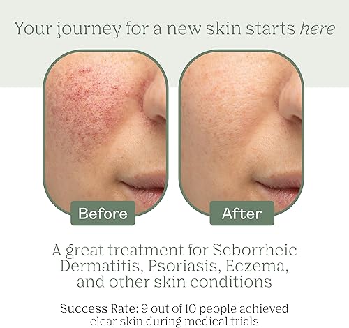 Miniatura 3 de Dermabon Paquete de barra de jabón de crema para dermatitis seborreica y psoriasis Extracto de caléndula, ácido salicílico y crema de cera de abeja