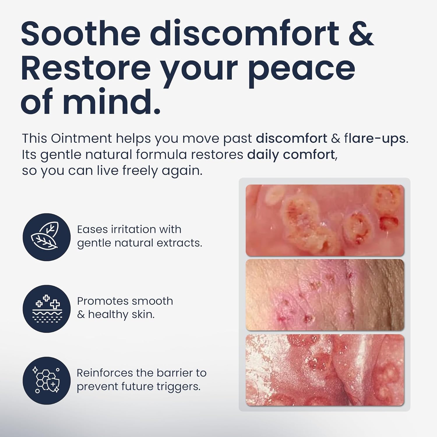 Genital Herpes Treatment - Genital Herpes Ointment for Men & Women - Cold Sore Treatment Soothes Genital Sores, Itching, Burning, Tingling & Irritation - Homeopathic Formula, 56g - Image 2