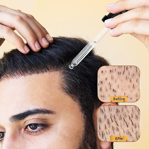 Miniatura 5 de 5 % de minoxidil para hombres y mujeres, aceite de suero de biotina minoxidil para el crecimiento de la barba, detener el adelgazamiento del cabello