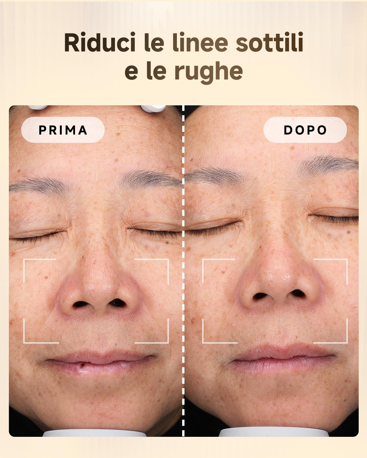 Luce del Latte Massaggiatore Viso Lifting Massaggiatore Viso a Infrarossi Pulsati Anti-rughe Anti-età Adatto per Pelle Sensibile