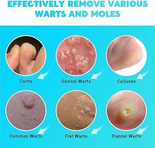 Miniatura 4 de Gaayou Lápiz Eliminador de Verrugas Ácido Salicílico Líquido Eliminador de Verrugas Profesional de Acción Rápida Seguro para Cara y Cuerpo, Piel