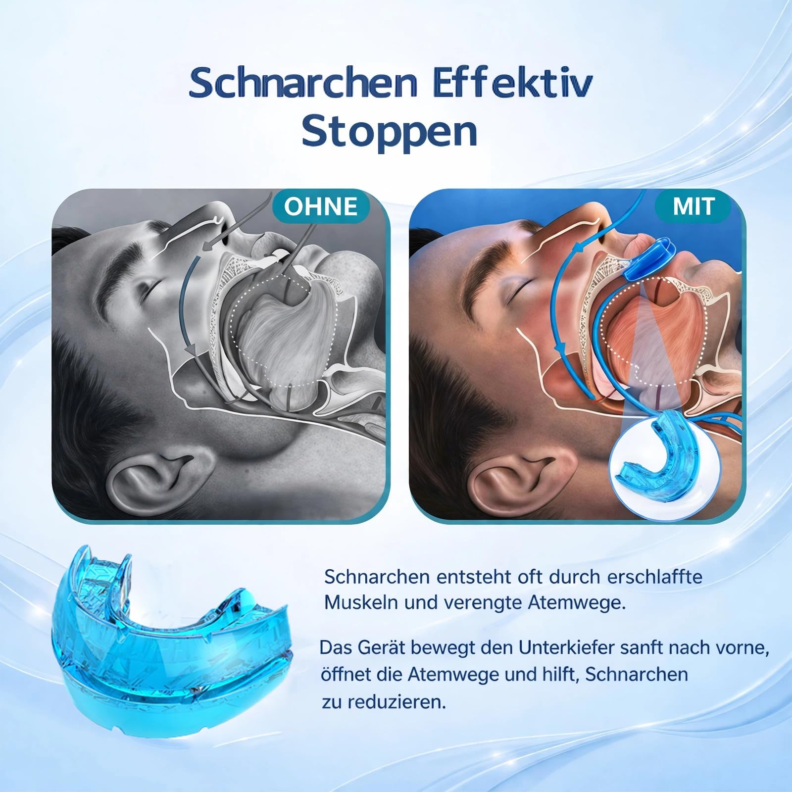 Schnarchstopper Anti Schnarch, Schnarchschiene gegen Schnarchen, Reduziert Zähneknirschen, Verbessert den Schlaf für Männer und Frauen (Blau)