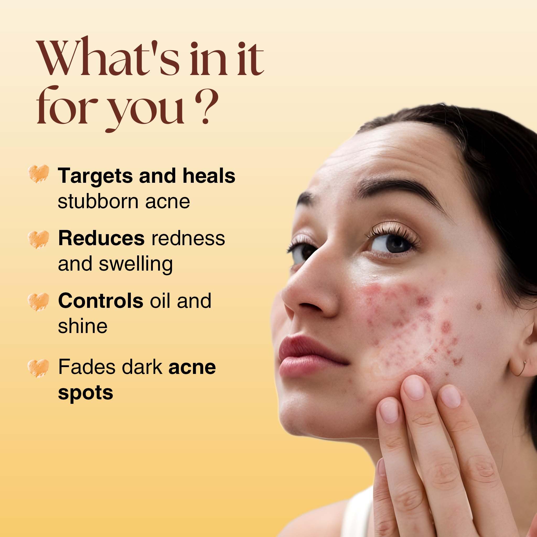 Siya Ayurveda Acne Spot Corrector Gel For Reducing Active Acne |1% Niacinamide and 2% Salicylic Acid Reduces Pimples, Blackheads, & Whiteheads 1