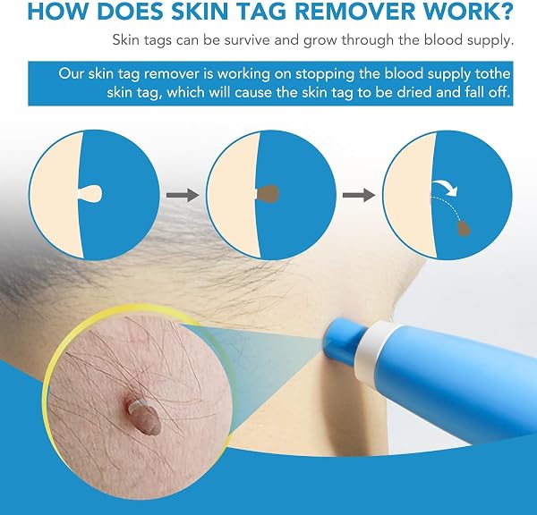 DermaSkin Pro - Adieu Les Acrochordons Améliore La Douceur De La Peau Indolore Et Facile À Enlever Pour Femme (Bleu 1 ensemble) - 3