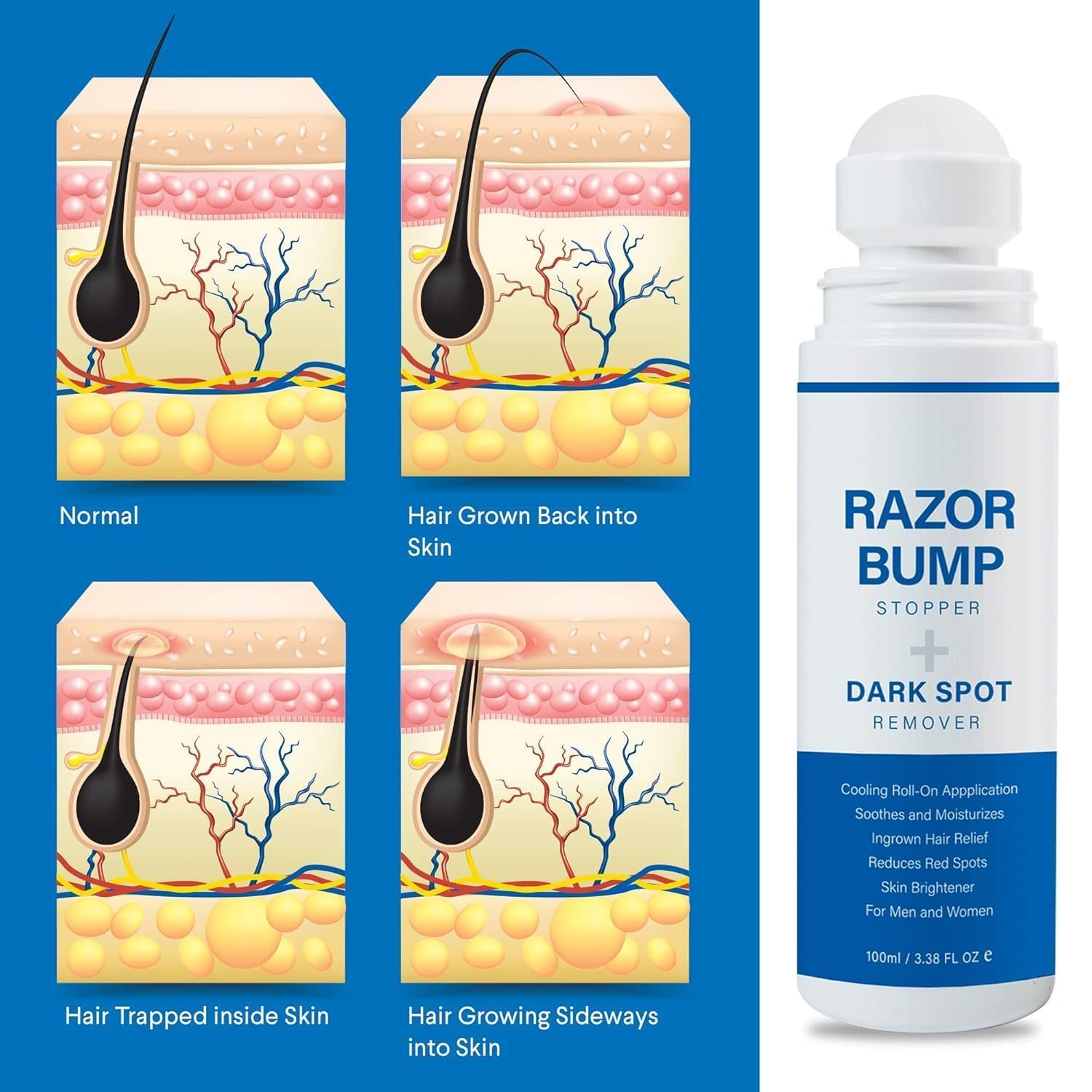 Razor Bump Treatment - Stop Ingrown Hairs & Burns -3 Razor Bump Treatment - Stop Ingrown Hairs & Burns -3