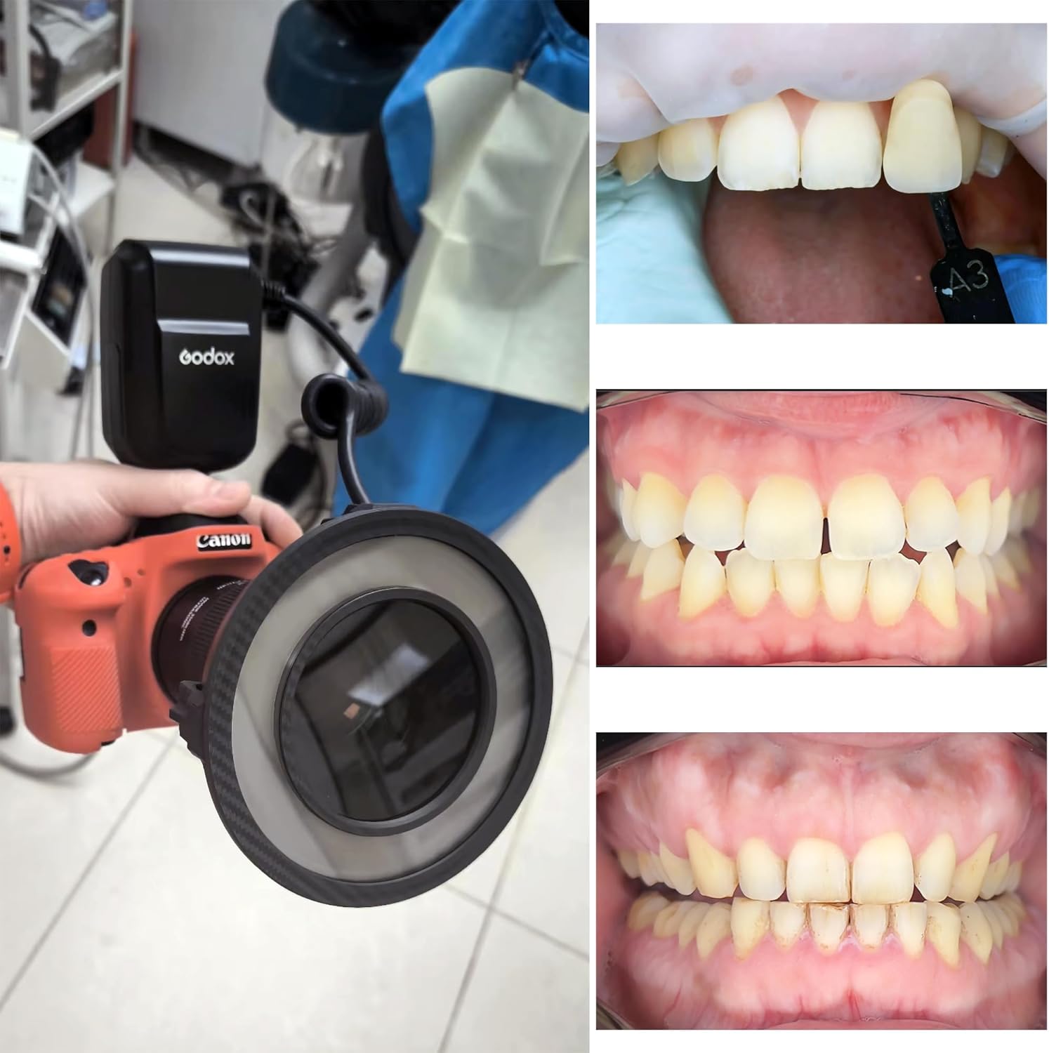 Cross-Polarization Filter Set for Godox MF-R76 Flash Ring - Dental Photography Polarizer Set. No Glare, No Reflections Camera Photography