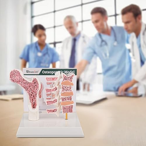 Miniatura 5 de Ultrassist Modelo de anatomía humana de osteoporosis - Modelo seccional de esqueleto de vértebras con tarjeta de estudio para demostración de
