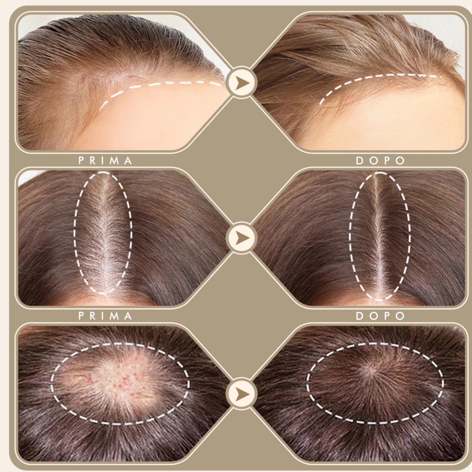 Derma Stamp, Dermastamp Regolabile 0-3mm 120 Titanio Aghi + 64 Titanio Aghi Professionale, per la Crescita dei Capelli, Barba, Viso, Corpo, Viso, Uomo e Donna