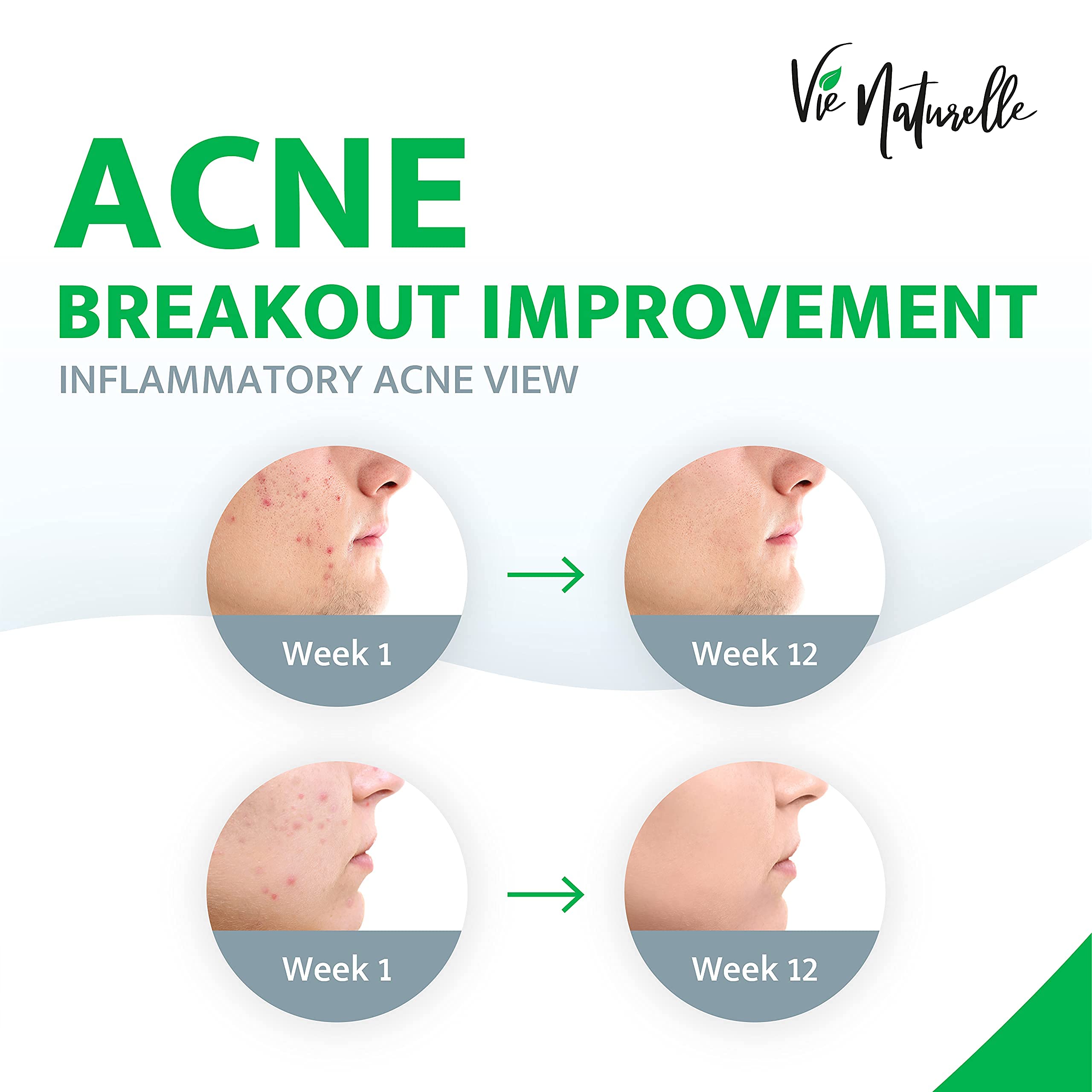 Natural Acne Treatment Cream with Benzoyl Peroxide Spot Treatment