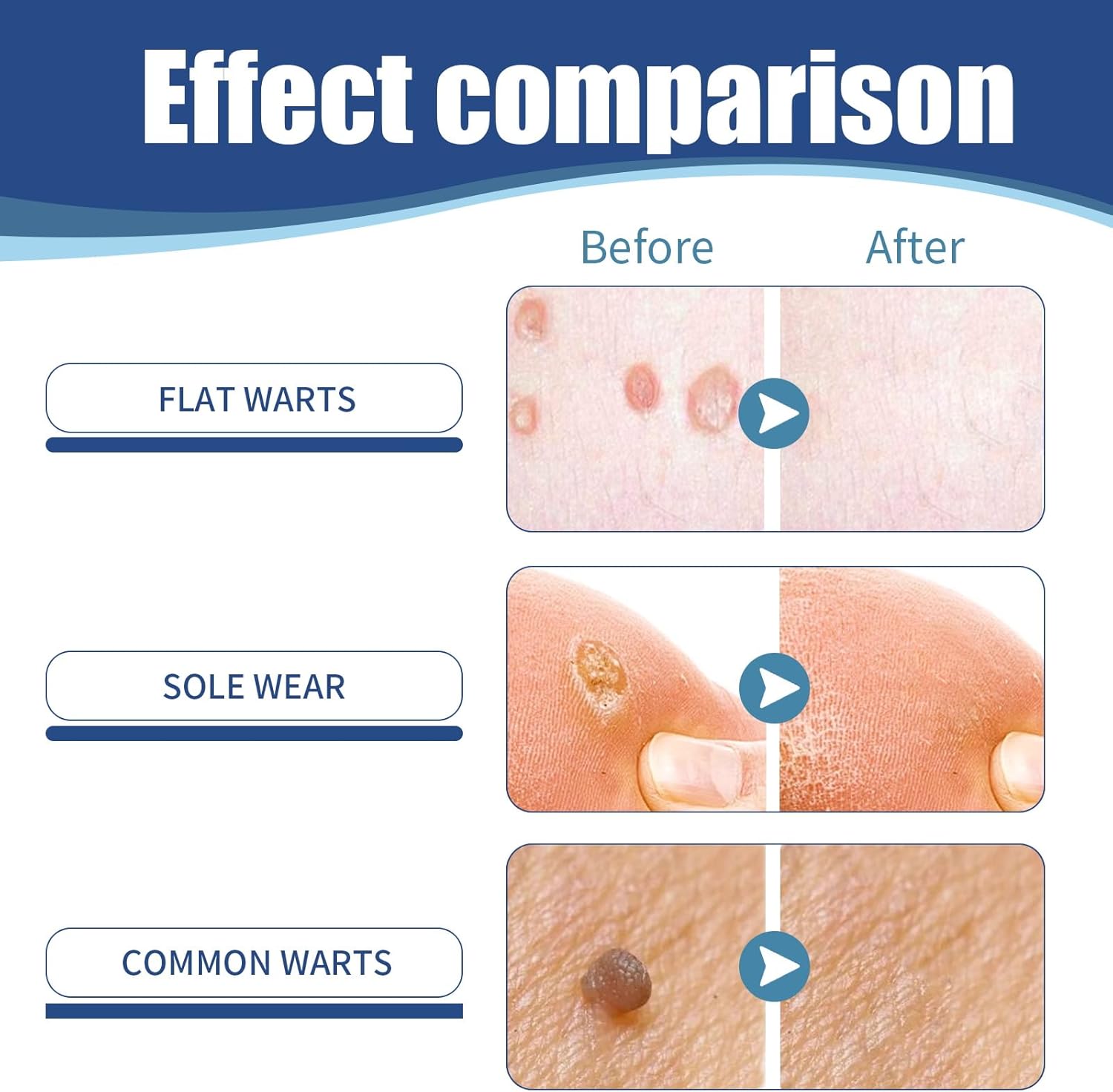 Fast-Acting Wart Remover Gel for Feet & Hands, Nature Plant-Based Formula - Genital, Common Warts & Plantar wart Remover, Safe for Kids & Sensitive Skin, Non-Invasive Home Care - Image 3