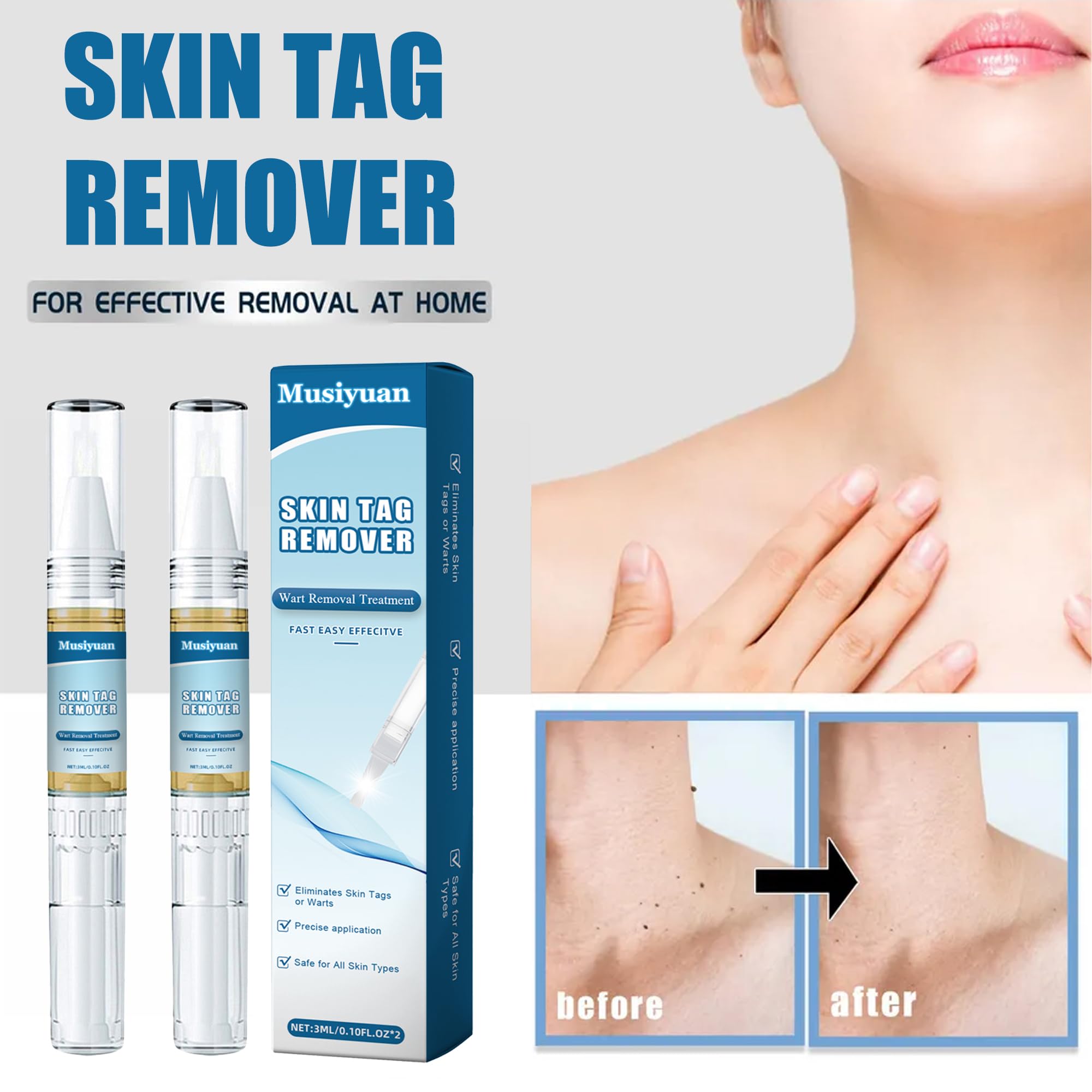 Lápiz removedor de verrugas, kit para eliminar verrugas en cuerpo y manos, apto para todo tipo de piel - Paquete de 2