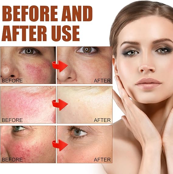 Rosacea Face Serum,Face Serum Hyaluronic Acid,Face Oil Anti-Aging,Relieve Redness &Quick Repair Damage Skin,Niacinamide Serum,Replumps & Hydrates,Collagen Face Serum-Protect Skin+Reduce Acne-Women