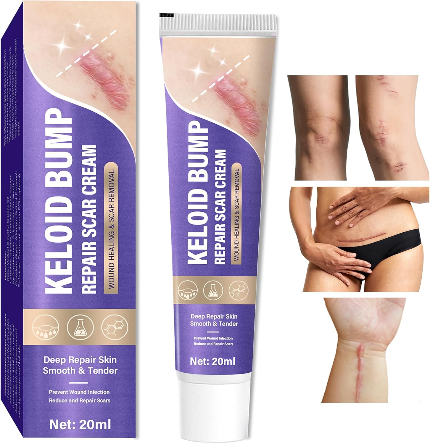 Keloid Bump Removal, Scar Removal Cream for Surgical Marks, Burns and Keloid Scar Treatment for Face and Body Healing