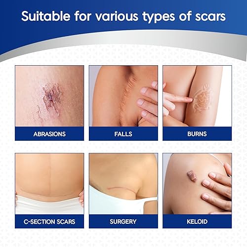 Miniatura 4 de MURASAKI BEAUTY Cinta y hojas de silicona para cicatrices  Eliminación de queloides, quemaduras, abrasión, cesárea y cicatrices quirúrgicas  Seguro