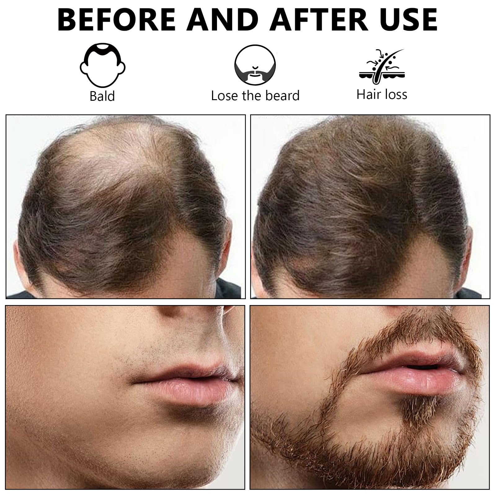Derma Roller, Dermaroller Cheveux 0.5 mm, Dermaroller Barbe avec 1200 Aiguilles Micro-Aiguilles, Roller Cheveux Repousse, Pousse Barbe, Microneedling Visage, Beard Roller, Massage Cheveux