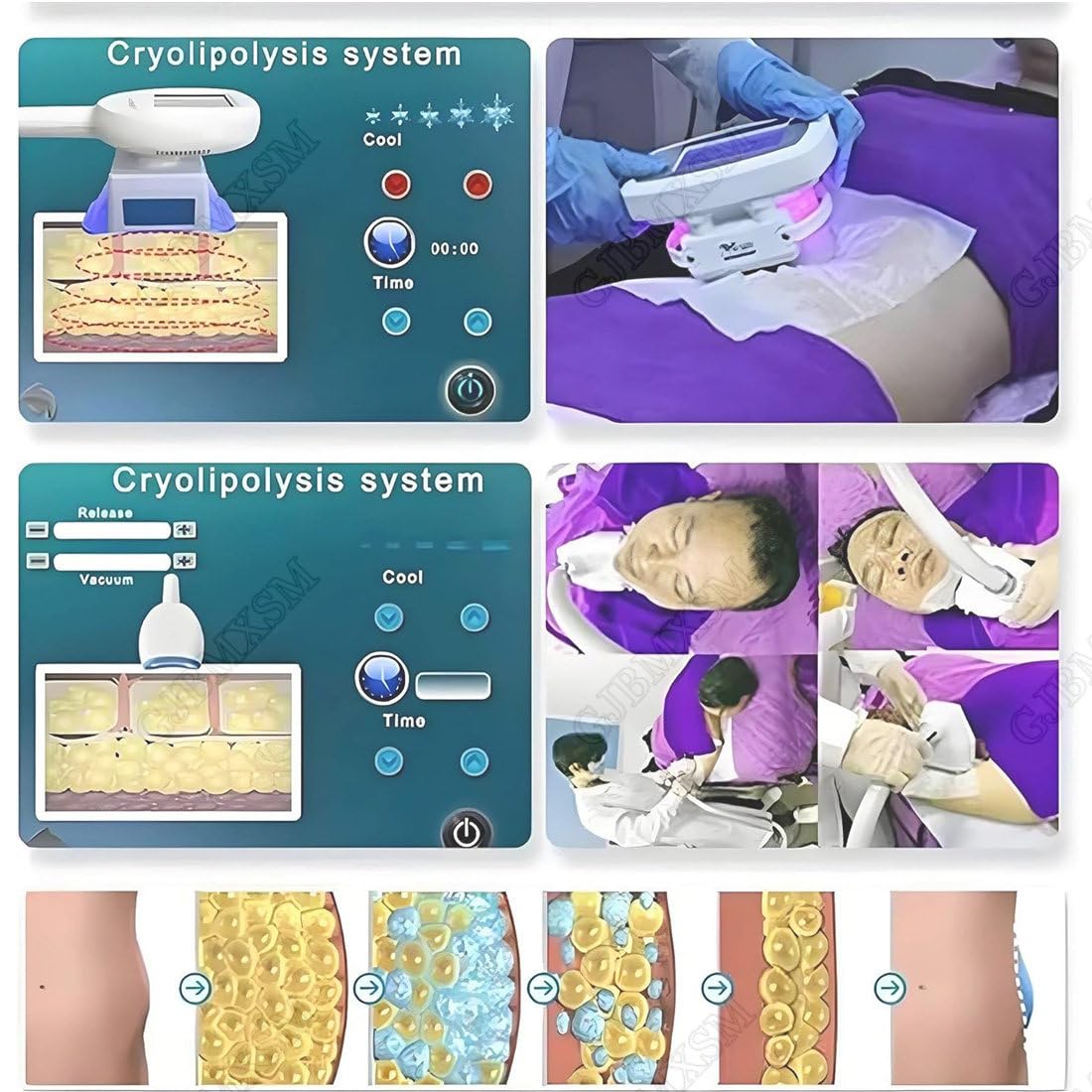 Fett Einfrieren Kryolipolyse Gerät, Professionelle Abnehmen Maschine Körper-Kryolipolyse-Vakuum für Gewichtsverlust, Fett Abbau, Cellulite verringern,Körperformung