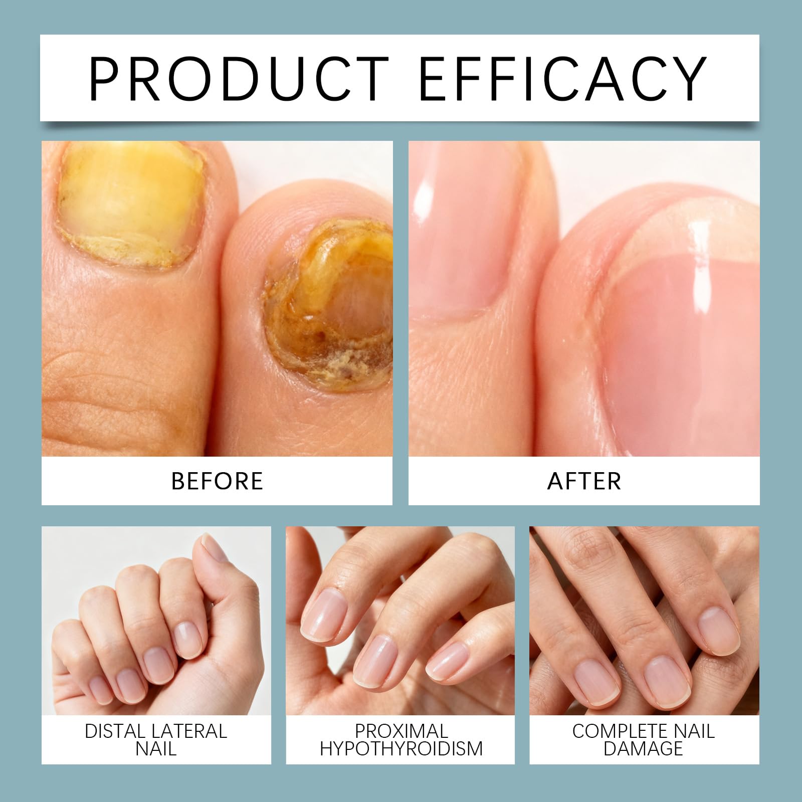 Huile de soin des ongles 3 jours, fortifiante et stimulante pour la pousse, hydratante et nourrissante pour les cuticules, adaptée aux ongles mous et fragiles, soin hydratant intense pour (12PCS)