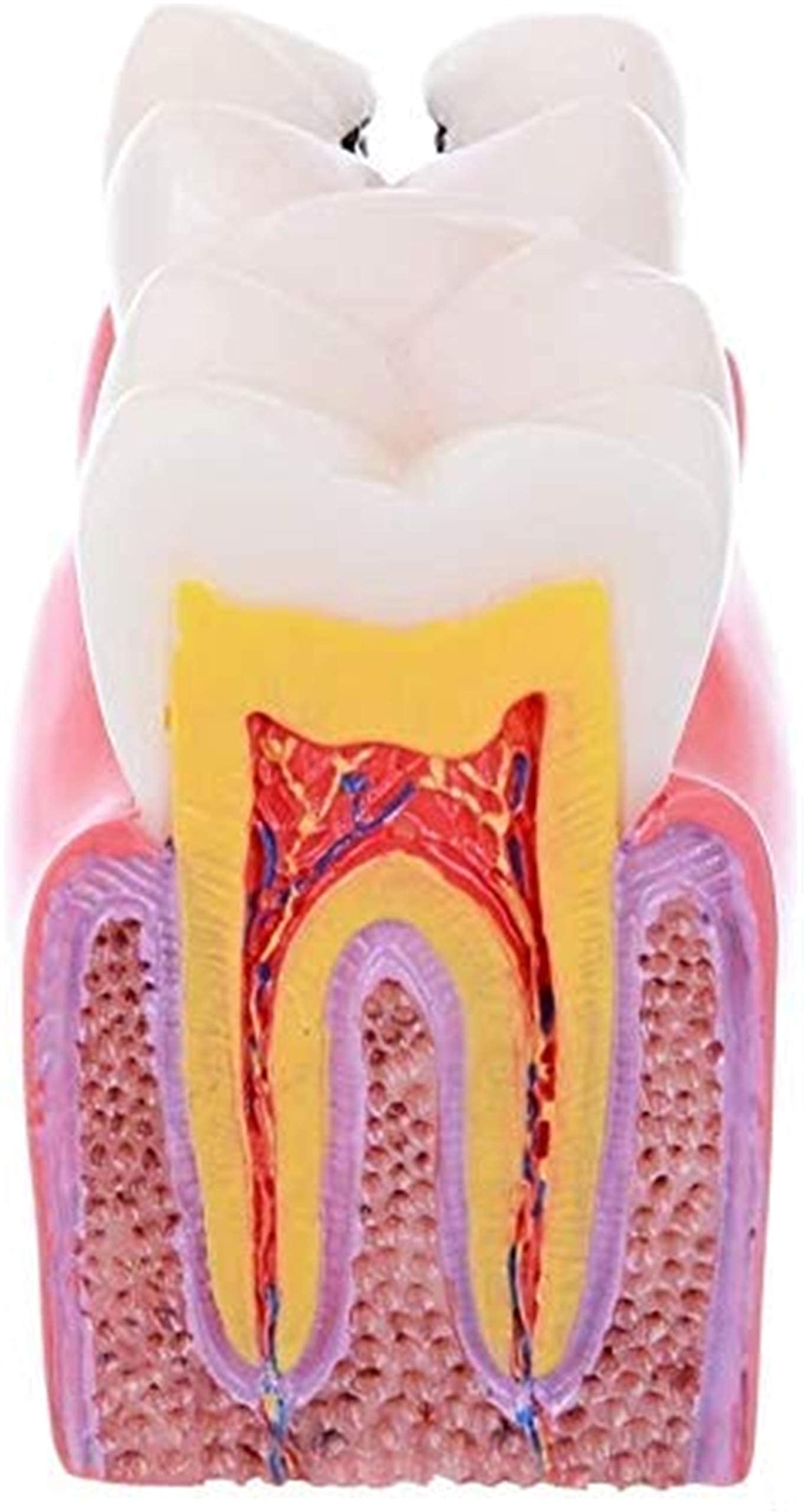 ERNZI Modèle Enseignement, Anatomie Dentaire, Modèle De Dents pour Étude Et La Recherche par Les Dentistes, Modèles Étude De Comparaison De Caries 6 Fois