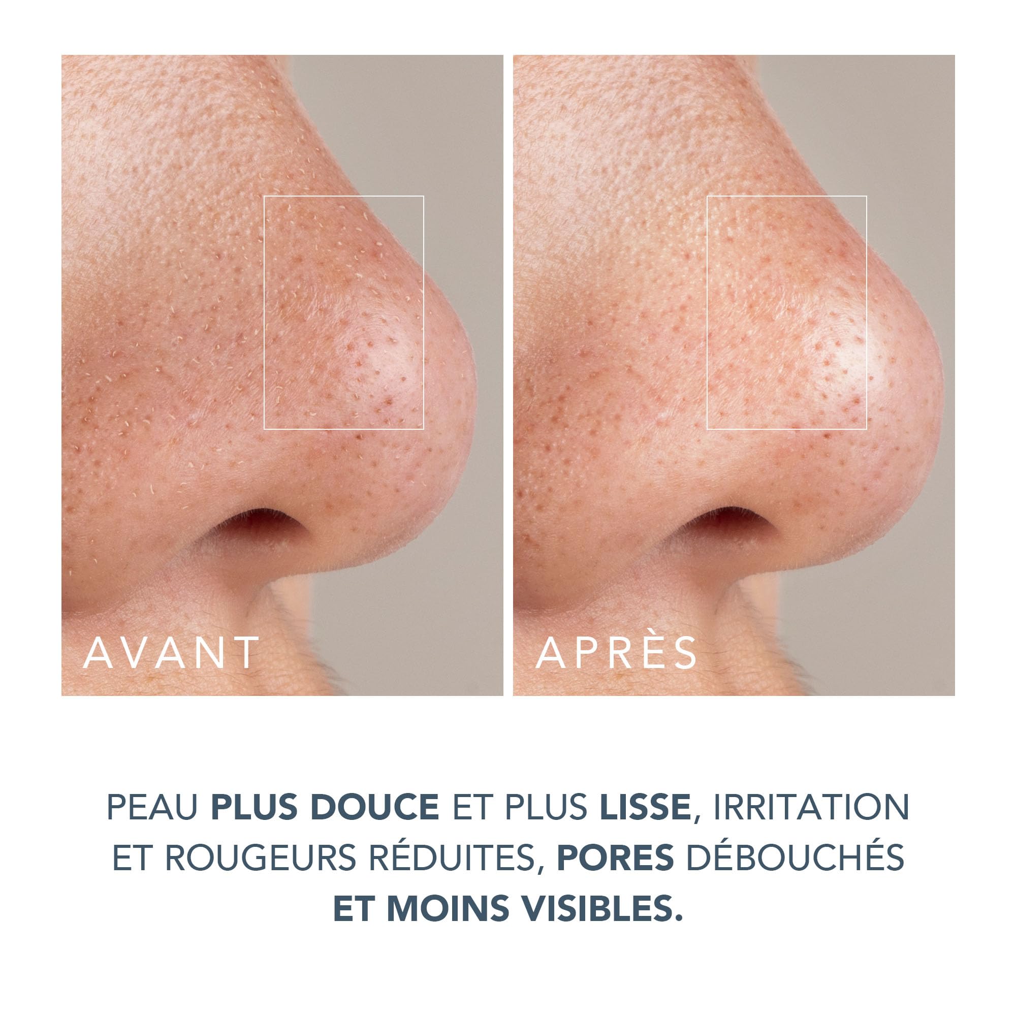 FOREO Smooth & Resurface KIWI derma Microdermabrasion - Extracteur point noir visage + KIWI Masque actif pores et points noirs 100g - Aspirateur point noir - Sans bandelettes - Aspirateur point noir