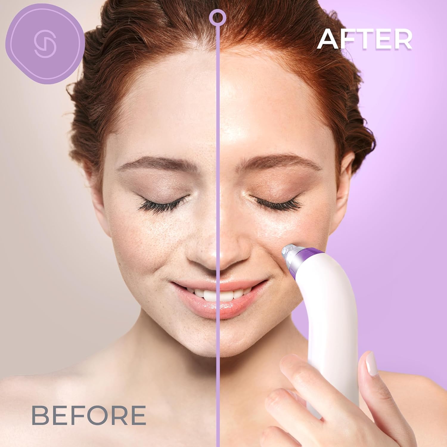 Essy Blackhead Remover & Pore Vacuum Cleaner for Face, Pimple Extractor & Skin Care Tool, Blackhead Remover for Nose Pore Extraction, Facial Tools to Pimple Sucker, Whitehead Vacuum Clean (Purple)