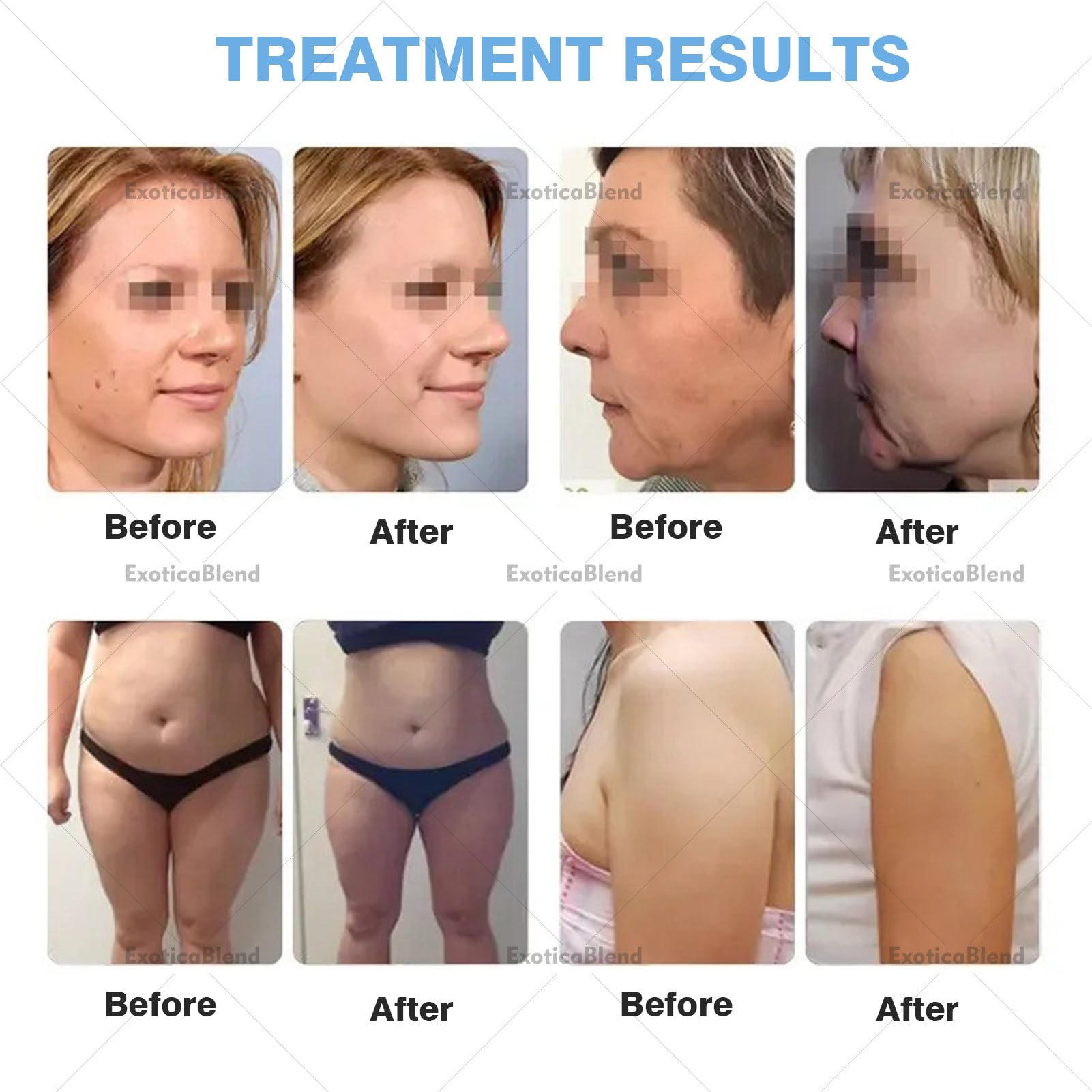 Hautstraffungsgerät, 7D-HIFU-Gerät, Facelift-Gerät mit 5 Kartuschen für intensitätsorientierte HIFU-Ultraschall-Gesichtsbehandlung zur Anti-Aging-Behandlung von Gesicht und Körper