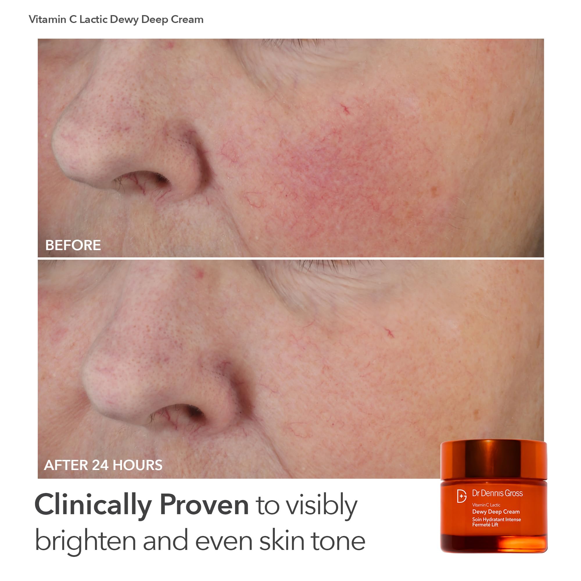 Dr. Dennis Gross DRx SpectraLite FaceWare Pro – LED Face Mask for Skin Rejuvenation with Dual Red & Blue Light Therapy, FSA HSA Eligible: Pink + Brighten Firm Kit