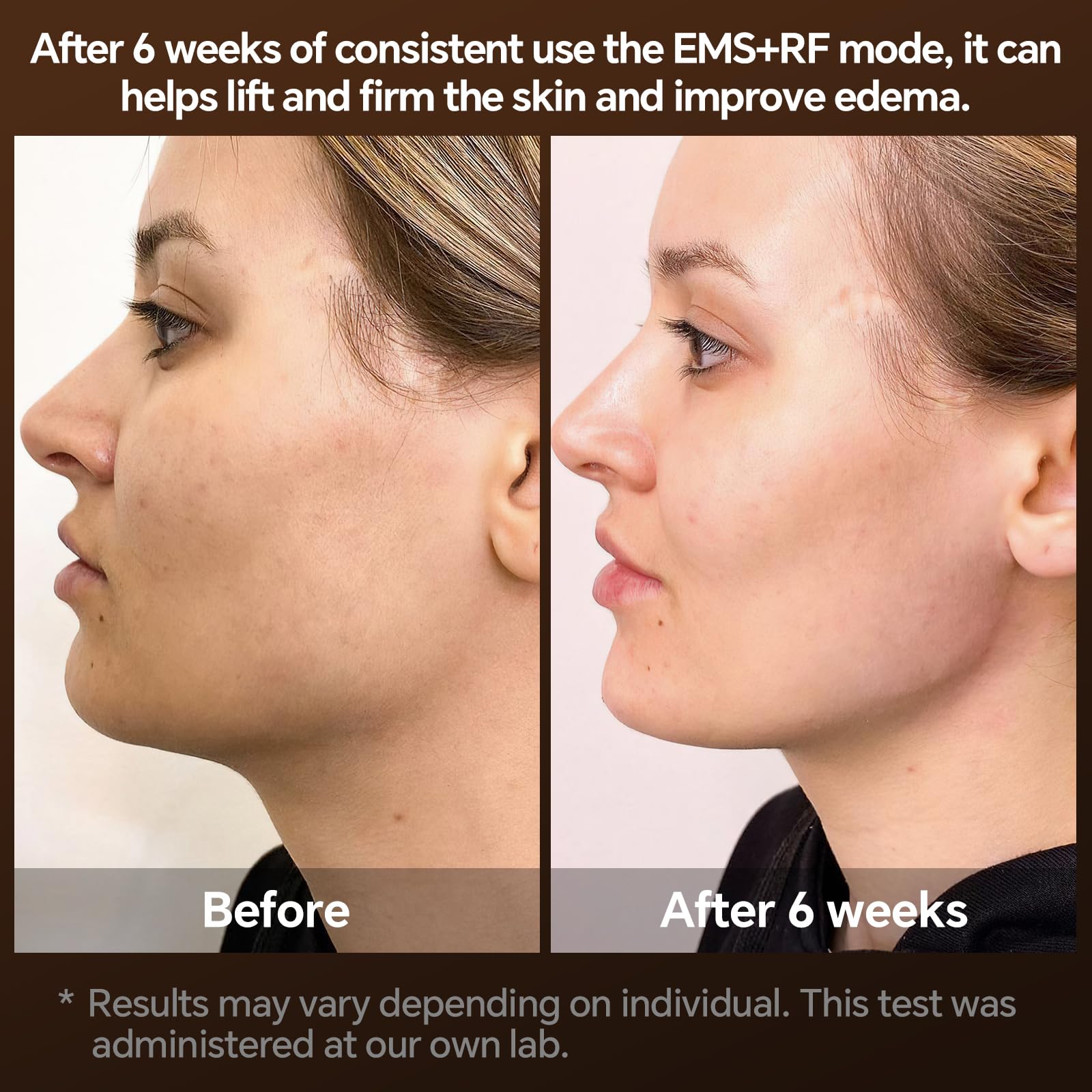 Radiofrequenz Gerät Gesichtsmassagegerät, 6 IN 1 EMS Gerät Gesicht Anti Aging Gesichts Massagegerät 3MHz RF Rotes blaues Licht, Gesichtsstraffungsgerät für Hautstraffung Hautpflege zu Hause