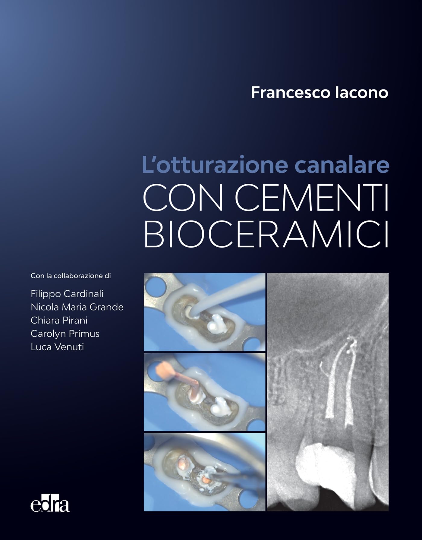 L'otturazione canalare con i cementi bioceramici