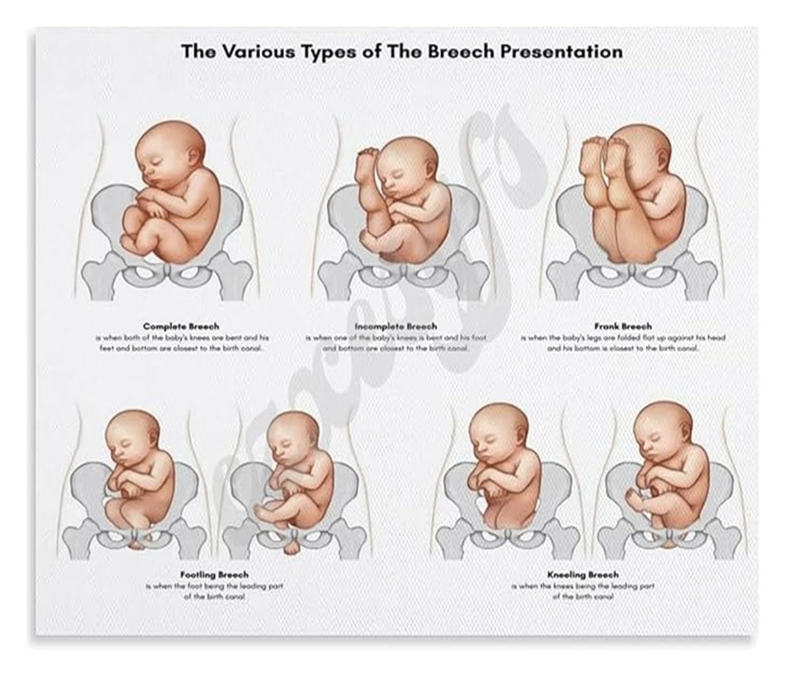 RNUMLIGH Fetal Malpresentation Poster Breech Types and Birth Options Educational Chart for OB GYN Office Decor(Framed,08x12inch(20x30cm))