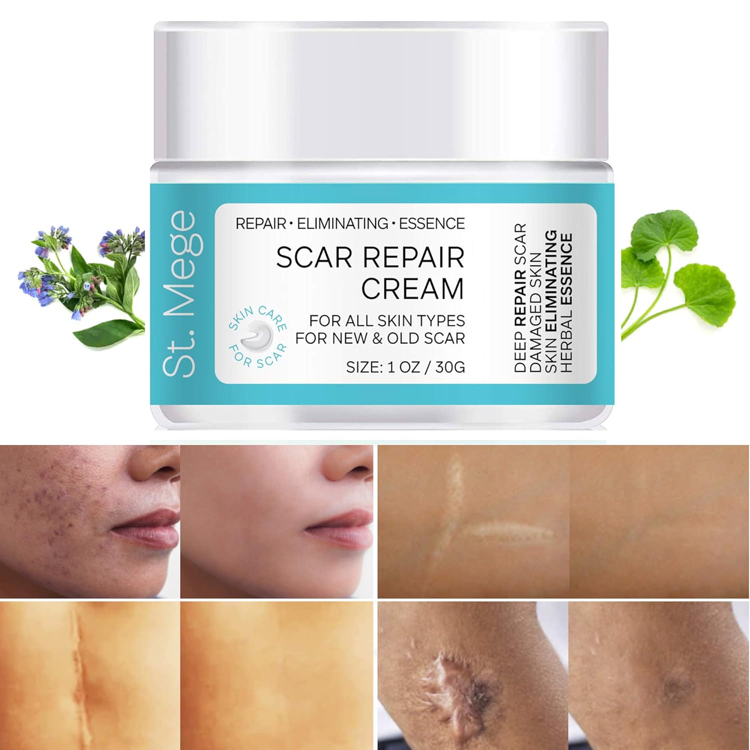 Scar Removal Cream, Scar Cream For Old Scars - Stretch Mark Removal Cream for Men & Women - Stretch Marks Relief and Burns Repair, Face Skin Repair Cream : Health & Household