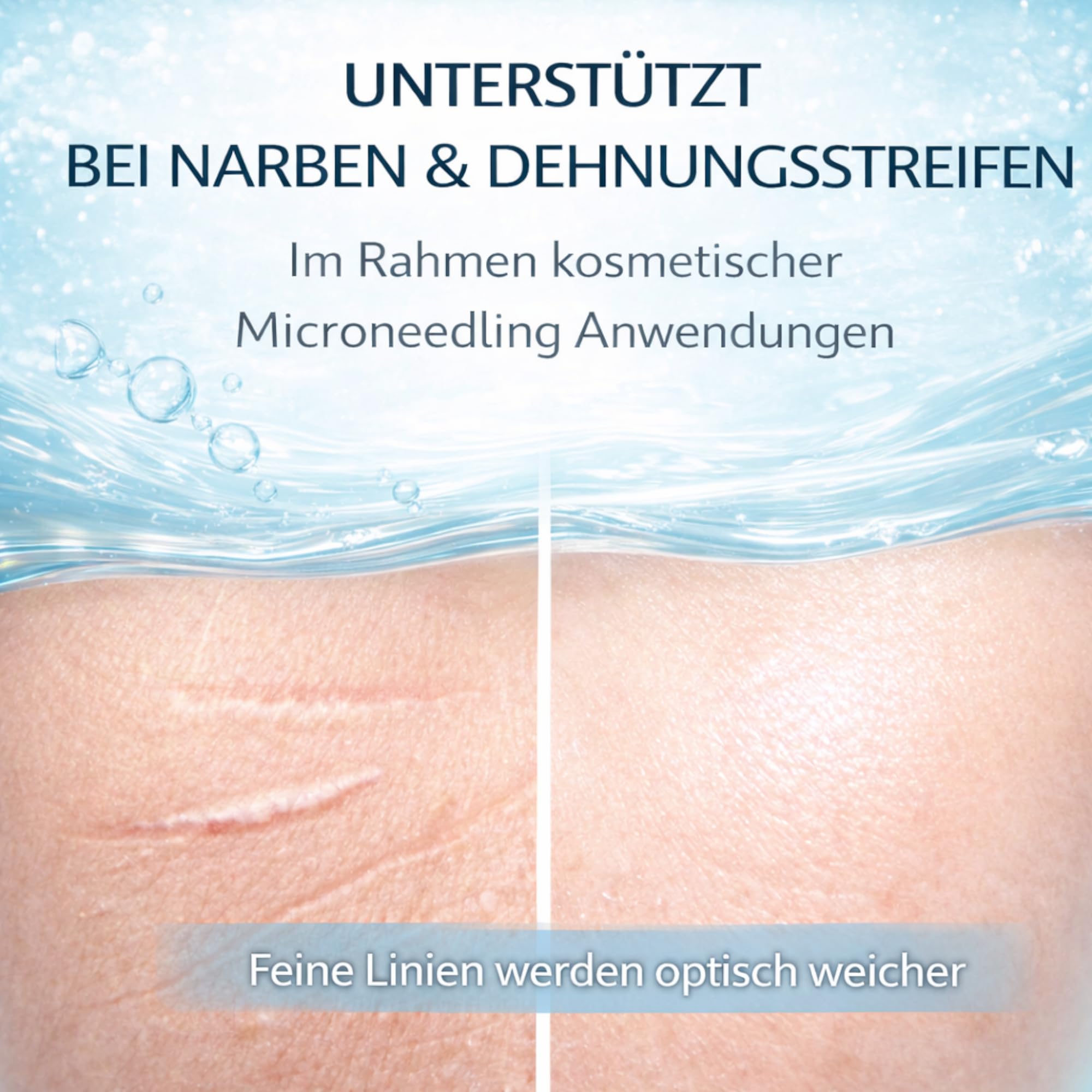Matrixneedling Siero ialuronico 3,5% – 3 booster di acido ialuronico – Siero sterile Microneedling per Dermapen & Dermaroller – Siero ialuronico altamente concentrato contro rughe, cicatrici e