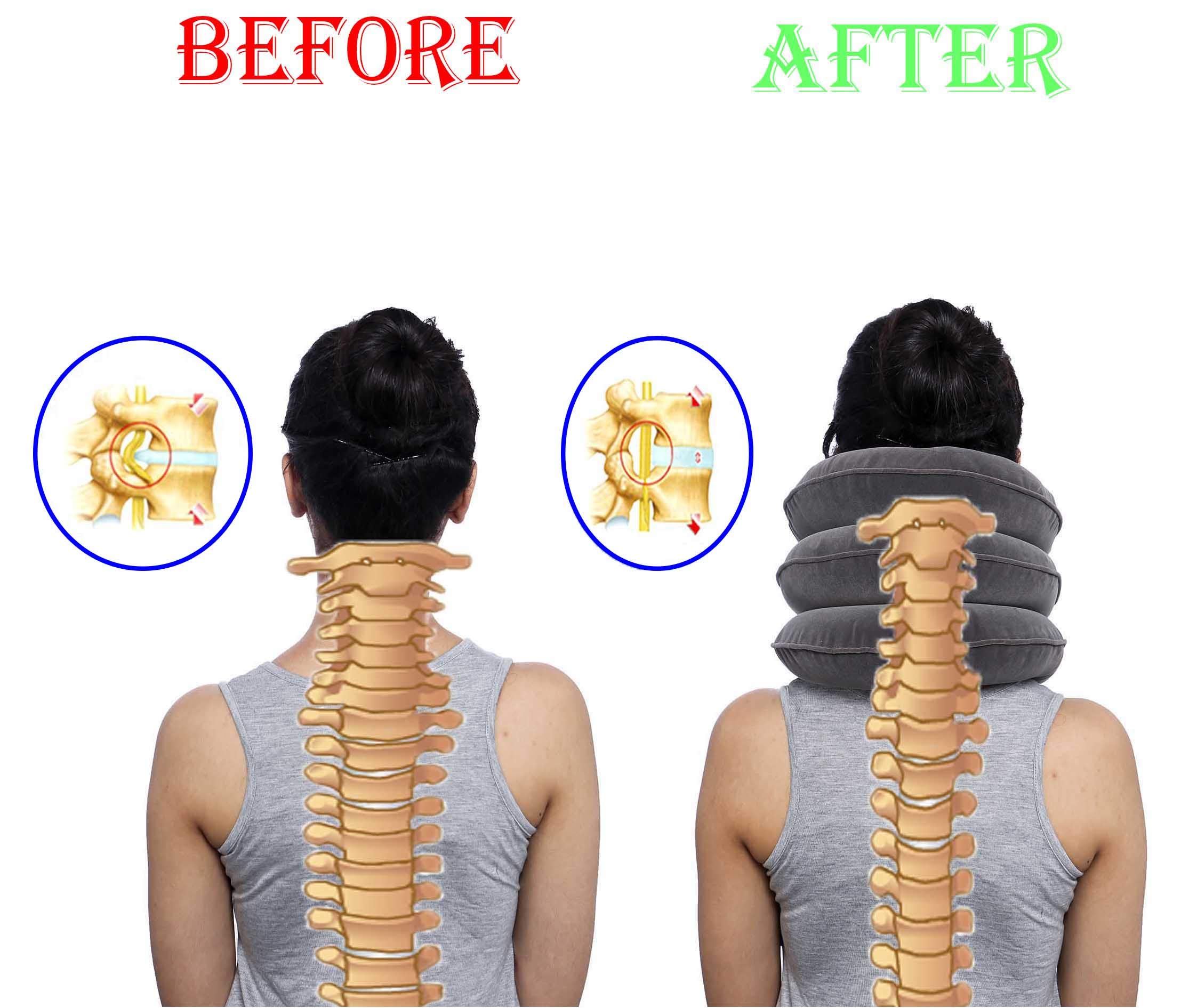 Inflatable Neck Traction Device, Cervical Traction Device for Neck, Neck Posture