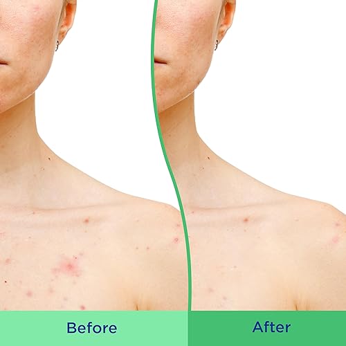 Miniatura 4 de Differin - Exfoliante corporal con ácido salicílico para eliminar el acné, mejora el tono y la textura de la piel en los hombros y el pecho, 8 onzas