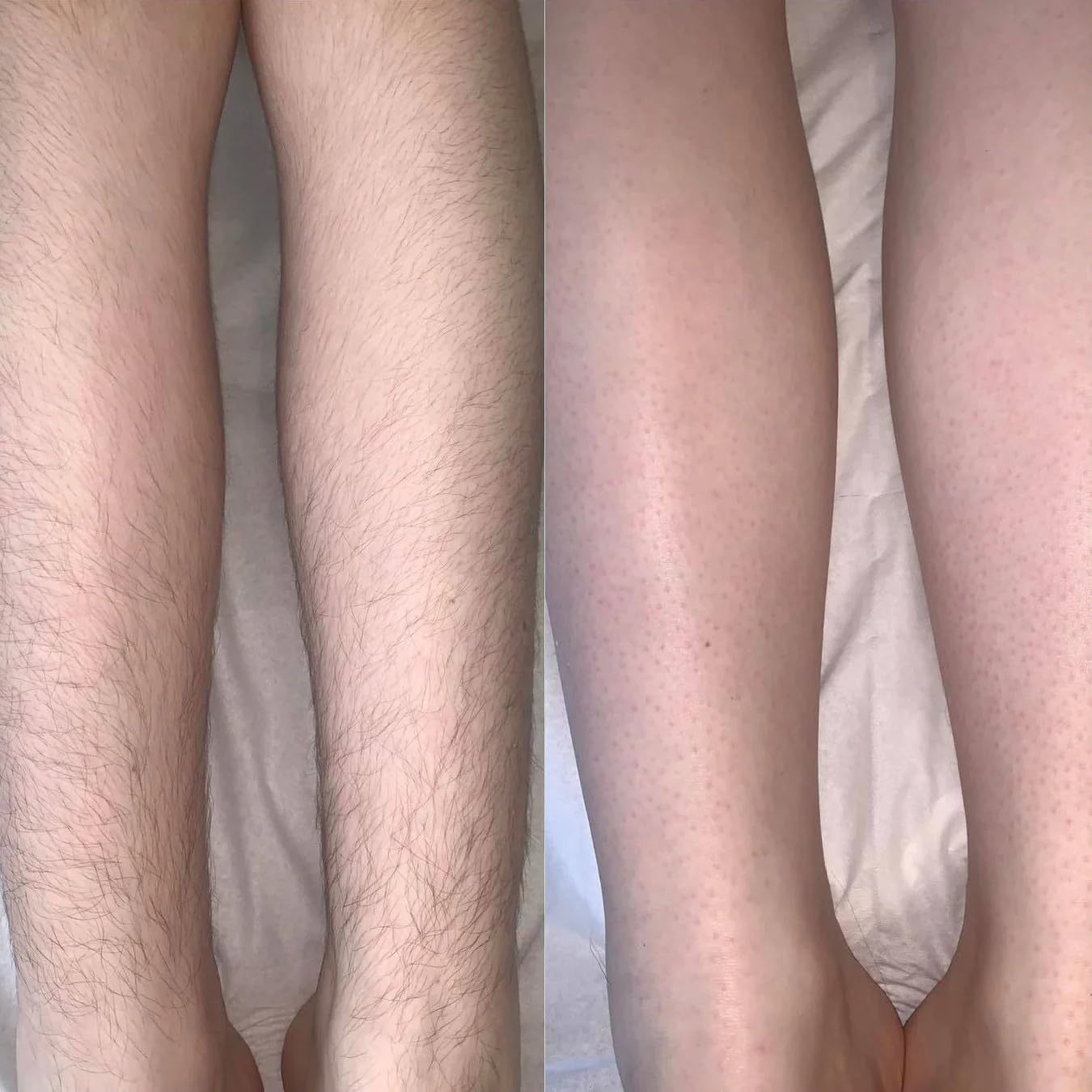 IPL Laser Haarentfernungsgerät für Dauerhafte Haarentfernung - Schmerzfrei - Achseln, Körper, Gesicht, Beine