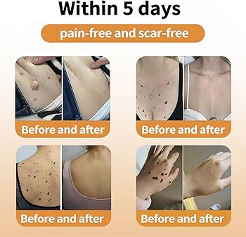 Be Cream 4個セット Amazon.com: Zoencgz Bee Venom Correcting Cream, Professional for