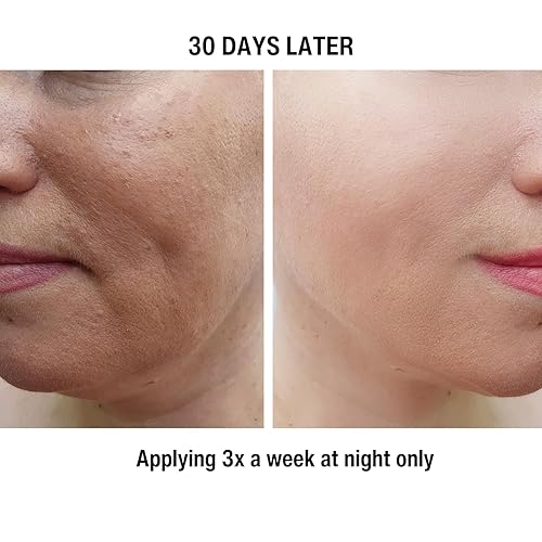 Miniatura 5 de Gymsegbe AHA - Tratamiento exfoliante 20% glicólico, 10% láctico para una piel radiante, suave y renovada – Pro Chemical Peel disuelve las células