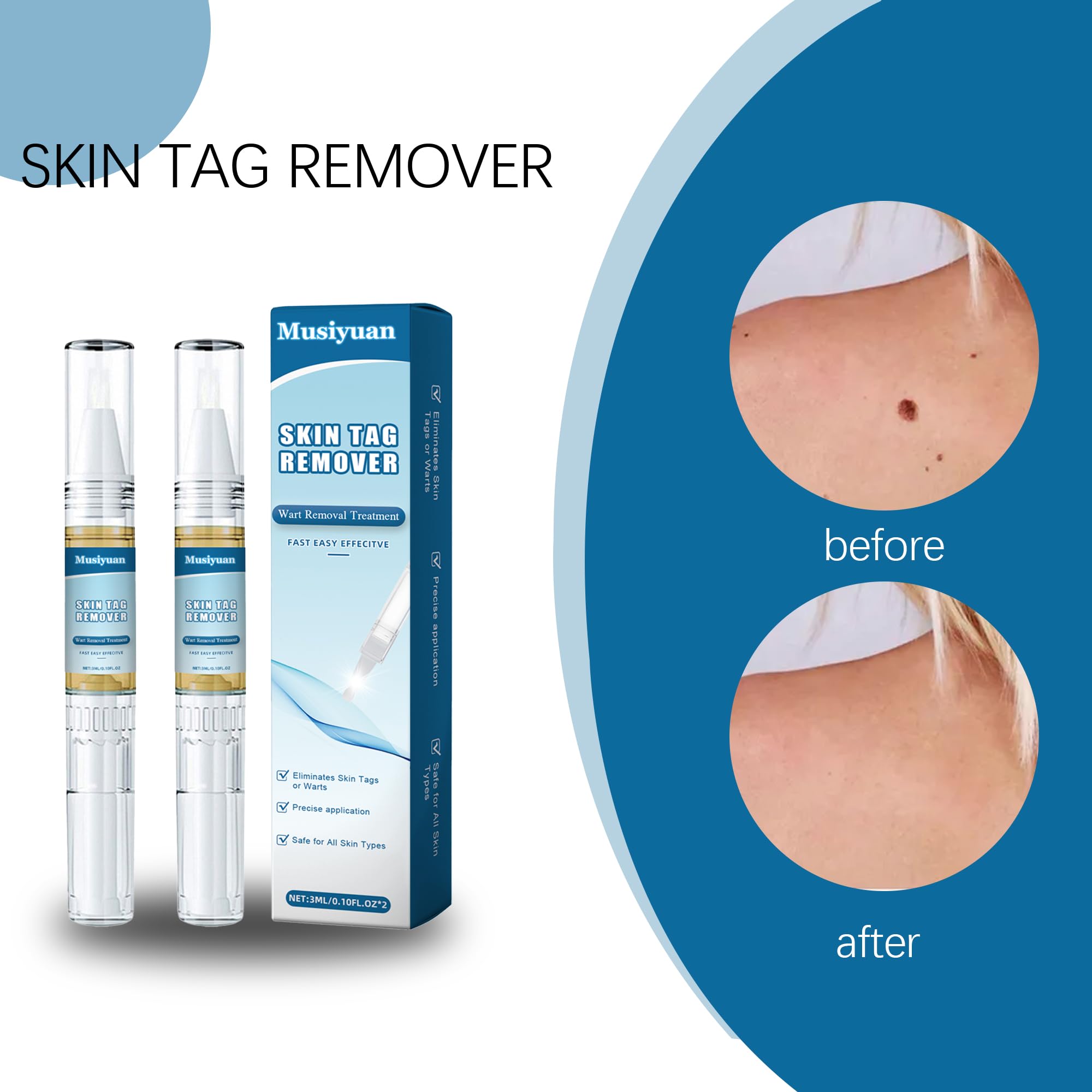 Lápiz removedor de verrugas, kit para eliminar verrugas en cuerpo y manos, apto para todo tipo de piel - Paquete de 2
