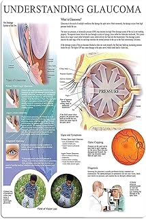 Understanding Glaucoma Medical Knowledge Canvas Wall Art Educational Infographic Poster Print for Hospital Doctor Clinic Office Wall Decor 20x24inch