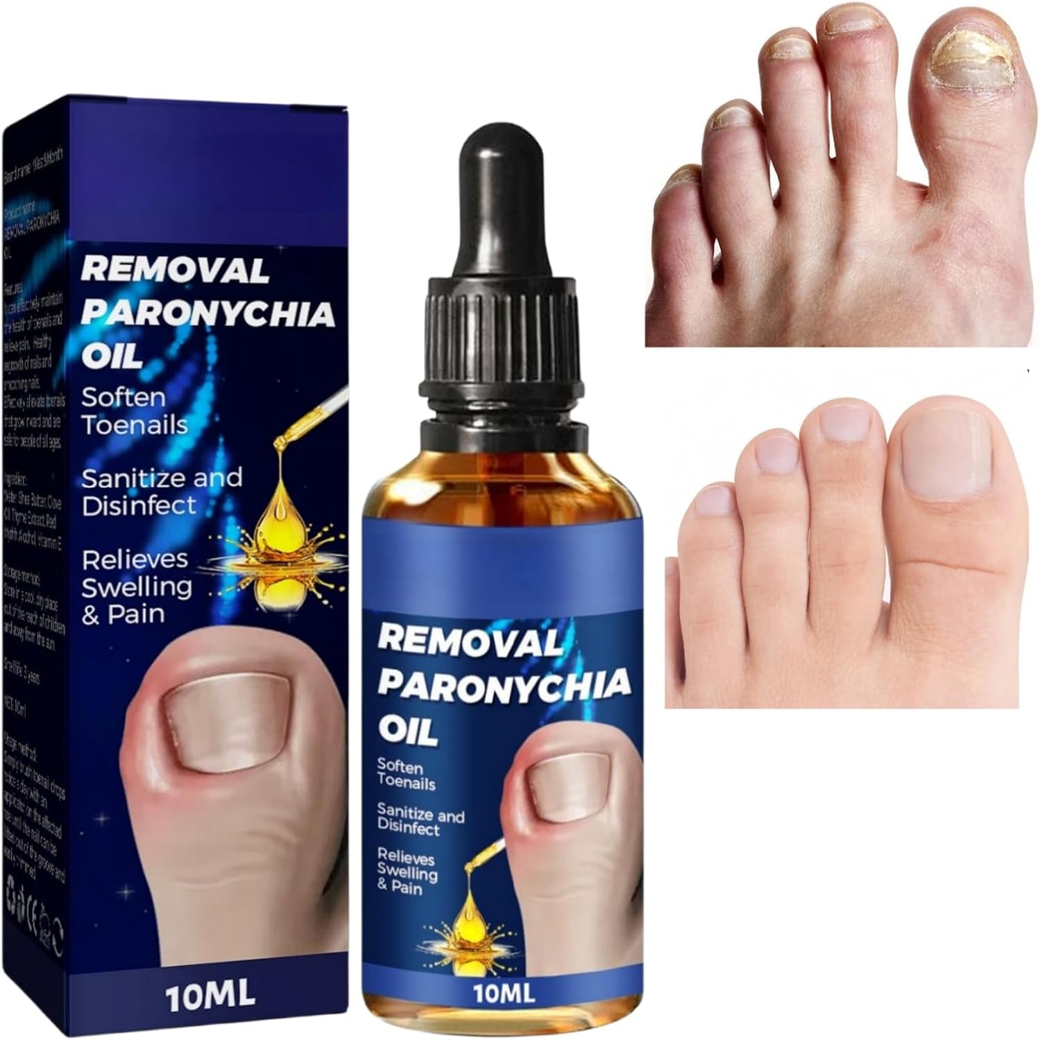 Ingrown Toenail Treatment,Ingrowing Toenail Treatment,Nail Growth