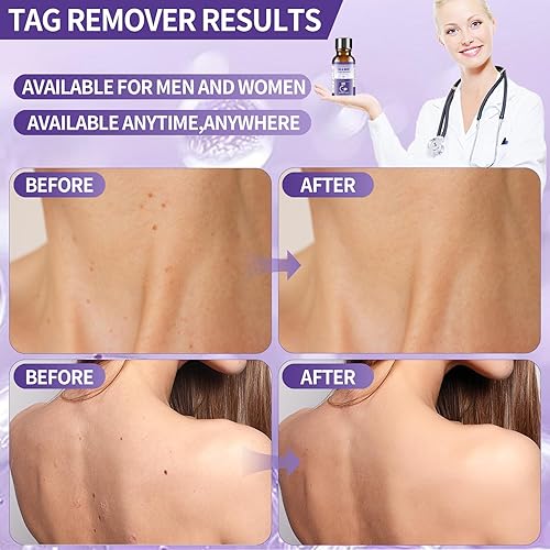 Miniatura 4 de ANTIXYL Kit líquido de eliminación de manchas cutáneas, removedor de maíz de verrugas, de acción rápida, congelación, 8% de eliminación de verrugas