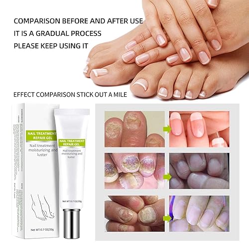 Miniatura 6 de Gel de paroniquia de eliminación de NARC, gel de paroniquia de eliminación de uñas alemán (2 piezas)