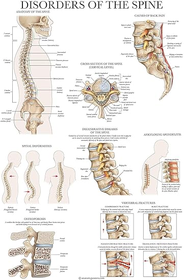 Disorders of the Spine Anatomy Poster - Laminated Spinal Disorders Anatomical Chart - 18