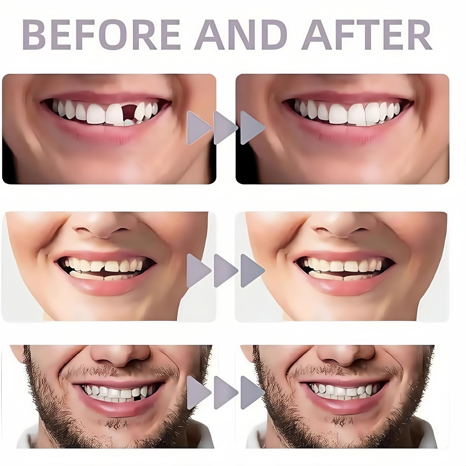 Kit de Prótesis Dentales de Silicona para Mujeres y Hombres | Prótesis Dental Temporal, Dientes Blandos, Protectores Bucales Instantáneos, Solución de Sonrisa y Boca Completa