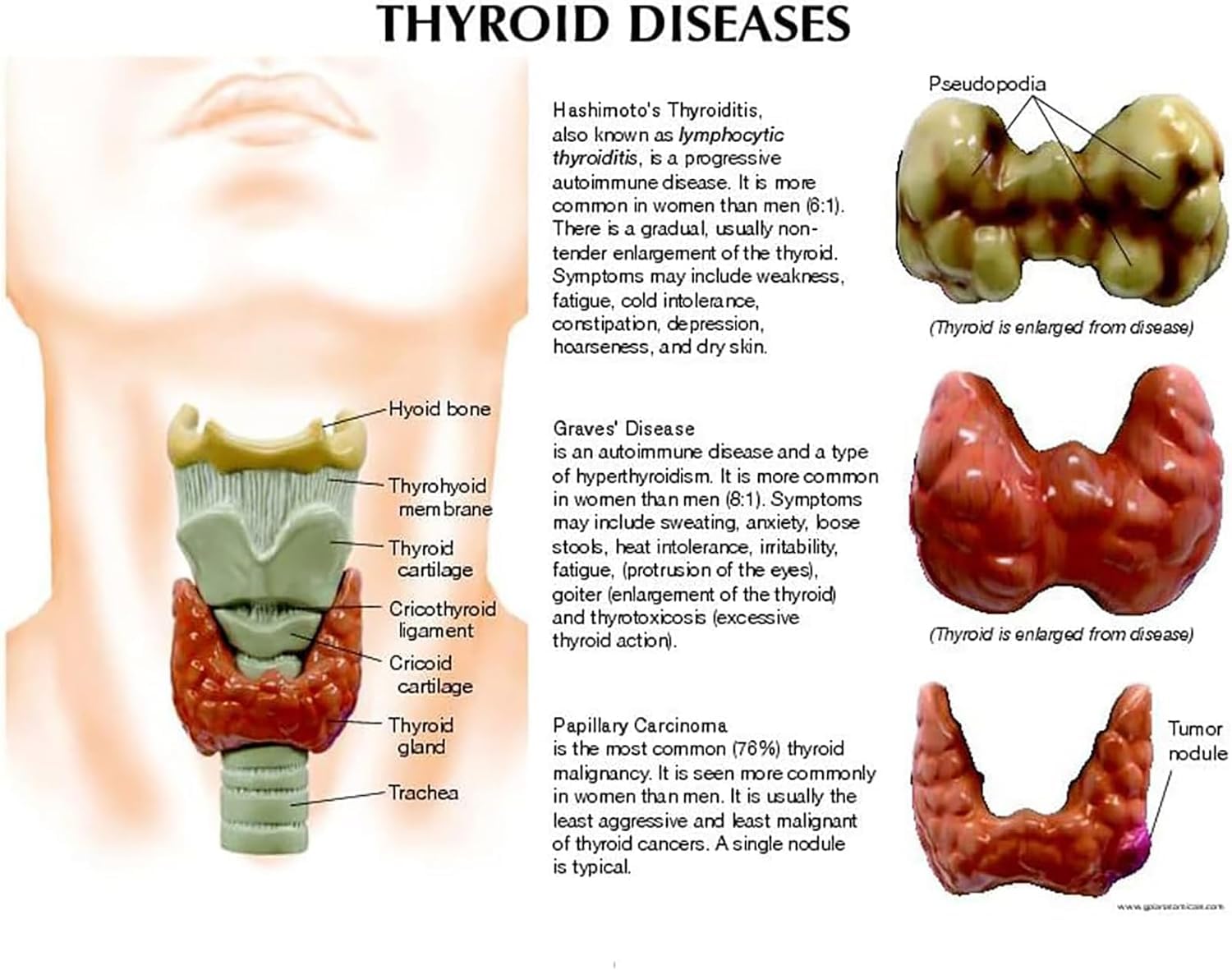 Modèle de glande thyroïde humaine, modèle d'anatomie normale et pathologique de la thyroïde humaine, échelle 3:1, illustrant le système digestif pathologique de la thyroïde. Modèle d'étude anatomique