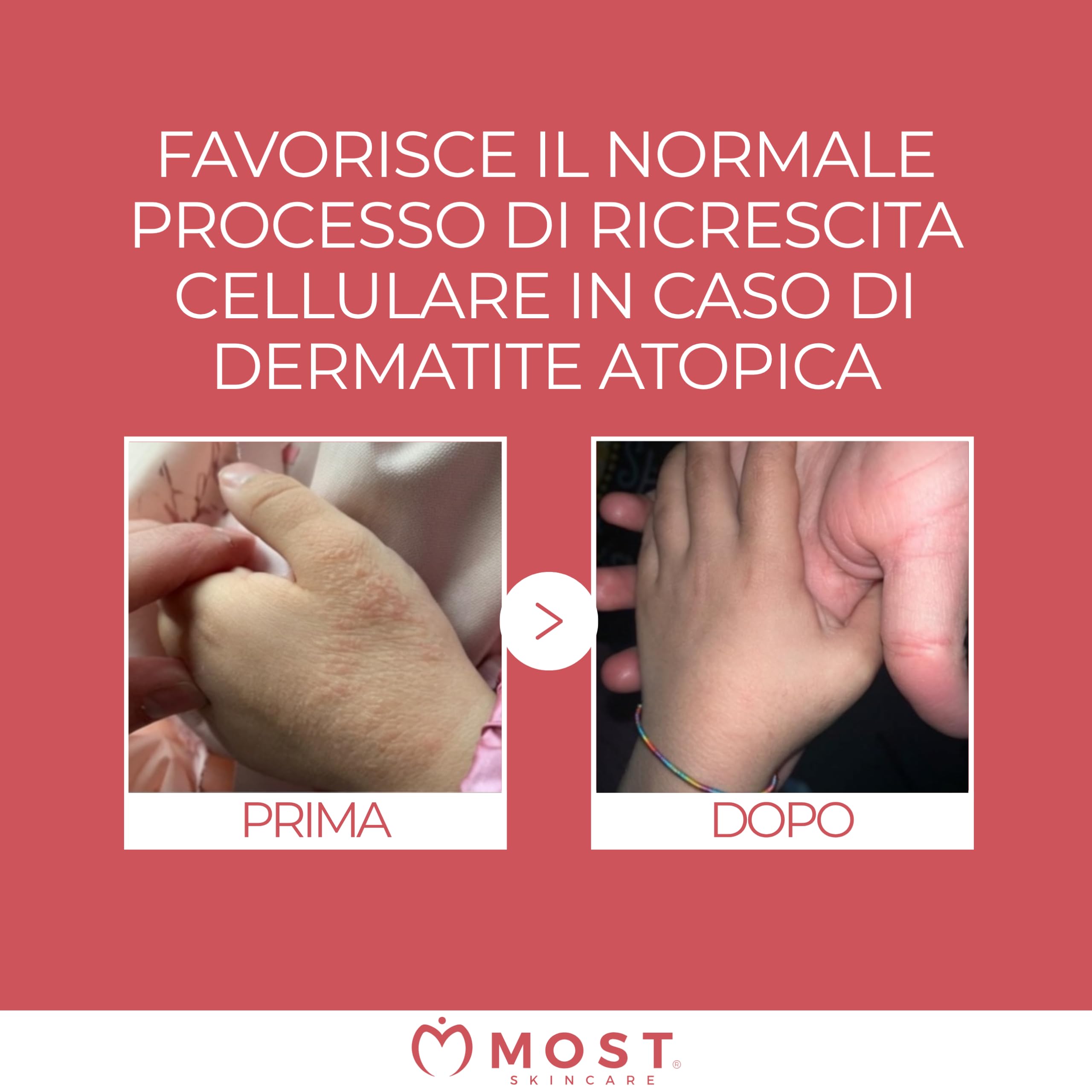 MOST - PEG Unguento Viso e Corpo Bambini e Adulti Lenitivo e Protettivo, Diminuisce Rossori e Stimola Processi di Riparazione Cutanea in Ragadi, Scottature Lievi, Cicatrici, Dermatite Atopica, 100 ml