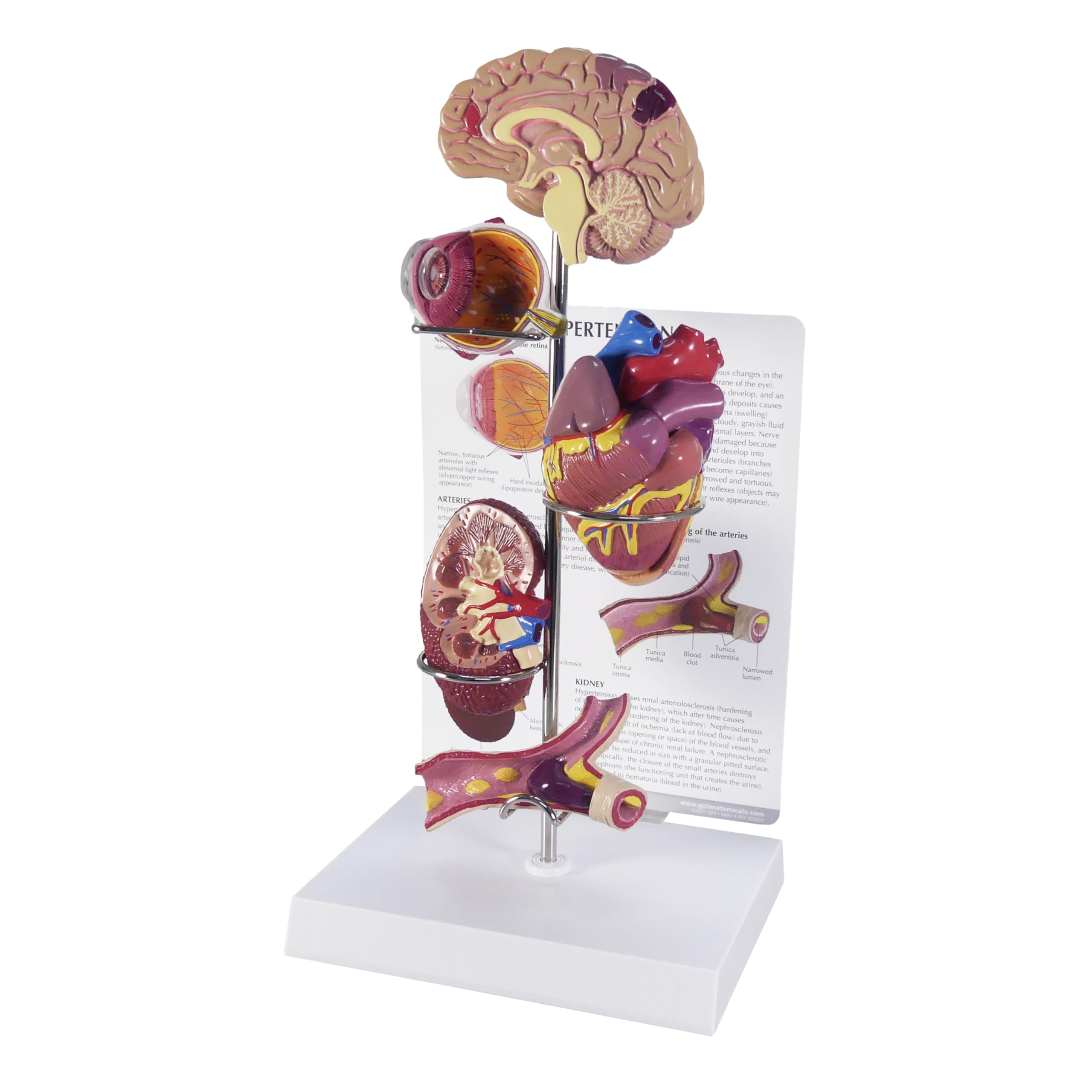 Sponsored Ad - GPI Anatomicals - Hypertension Model Set, Replica for Human Anatomy and Physiology Education, Anatomy Model for Doctor's Offices and Classrooms, Medical Learning Resources