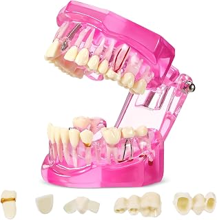 Outus Disease Teeth Model Dental Implant Teeth Model with Removable Tooth Dentist Standard Tooth Pathological Demonstration for Christmas Education Dental Supplies(Pink,1 Pcs)