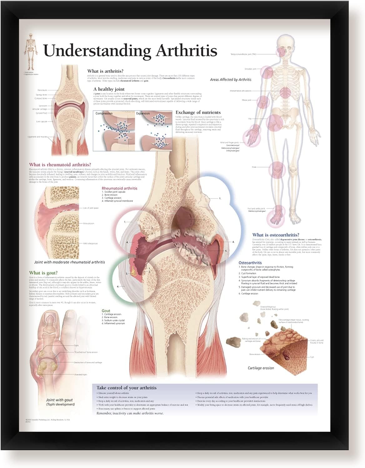 Understanding Arthritis Framed Medical Educational Poster Informational Diagram Doctors Office School Classroom 22x28 Inches