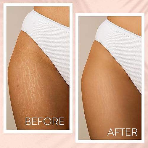 Miniatura 4 de Cariposa Removedor de aceite para estrías, aceite facial y corporal para mujeres, aceite de terapia de la piel con aceite de jojoba y almendras