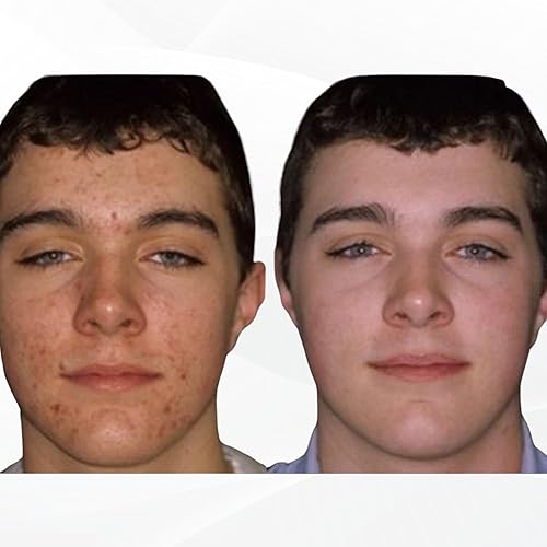 Miniatura 5 de Pastillas para el acné 30 días - Suplementos para el tratamiento vitamínico del acné - Tabletas para limpiar la piel grasa para mujeres, hombres,